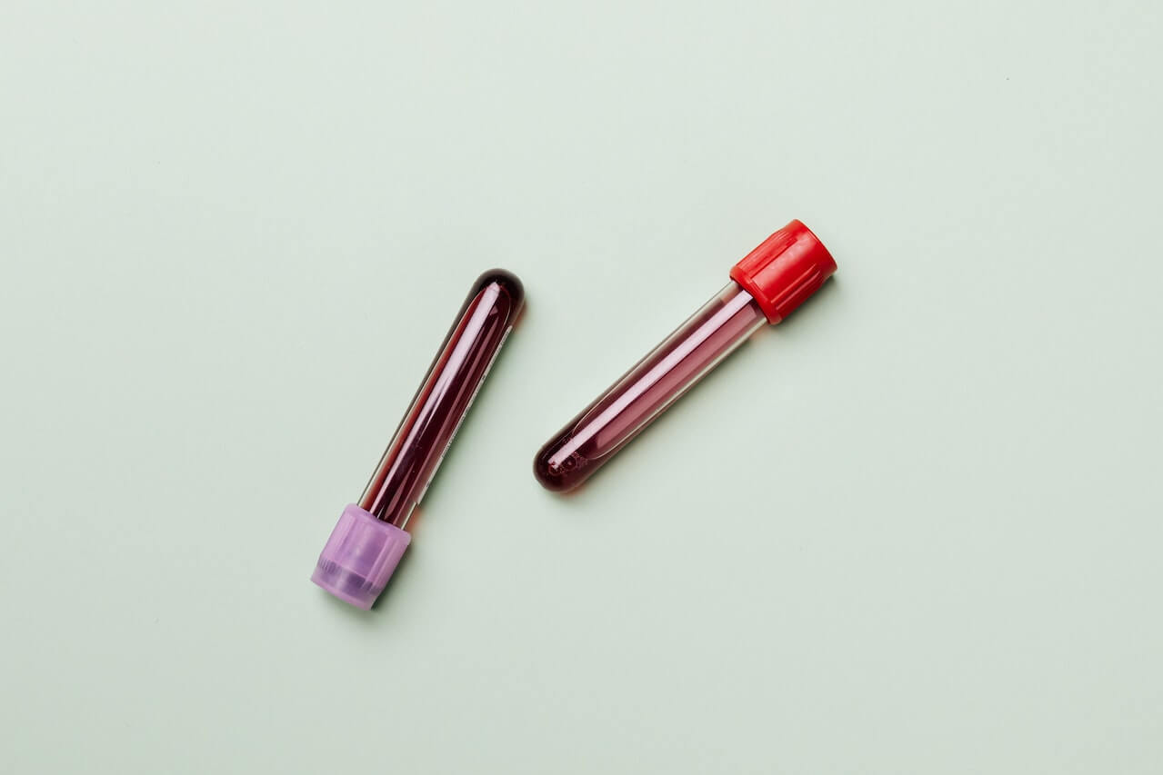 A close-up of two anemia panel blood test samples.